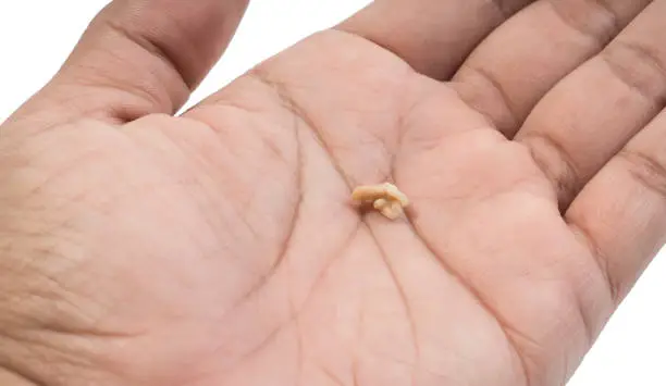 Photo of Tonsil Stone or Tonsillolith on the palm isolated on white background. Tonsil stones are hard deposits of debris that have lodged in tonsils.