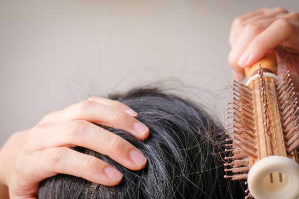 istock hair fall and lost alopecia woman problem on the comb. 1026742878