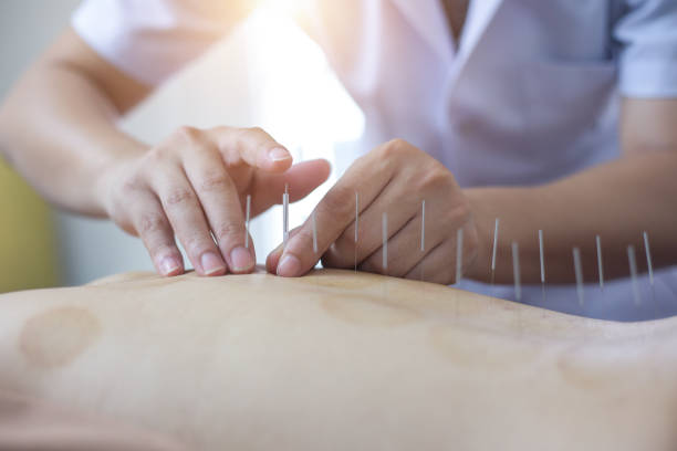 Traditional Chinese Medicine Treatment - Acupuncture Traditional Chinese Medicine Treatment - Acupuncture acupuncture photos stock pictures, royalty-free photos & images