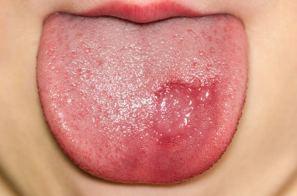 Geographic tongue disease on a caucasian child stock photo