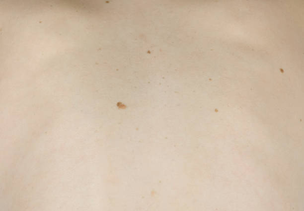 istock Woman's white skin in back with moles. View top. Camera movement from right to left. Close up back. 1027059004