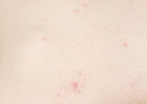 White and red pimples and acne on the man's back