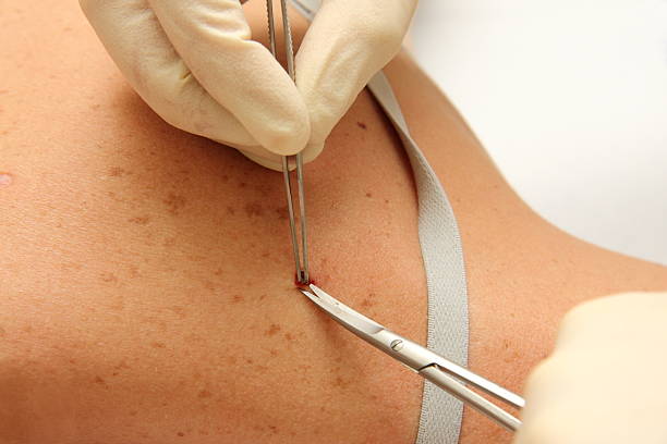 istock Doctor removing a mole from a patients skin 102747812