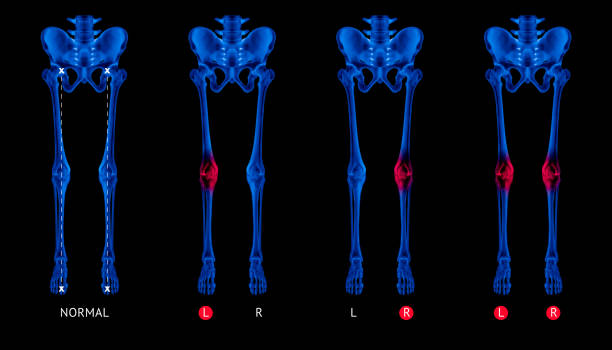 radiographie des os de jambe normale d’alignement ou position neutre jambe os vue antérieure rouge joyau dans l’arthrite du genou douleurs articulaires zone-3d illustration médicale - humain anatomie - medical concept - bleu couleur de tonalité - human joint human knee pain x ray photos et images de collection