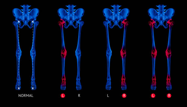 radiographie des os de jambe normale d’alignement ou de la position neutre jambe os vue antérieure rouge mettre en évidence dans l’arthrite de hanche-genou-cheville douleurs articulaires zone-3d medical illustration humain anatomie concept-bleu coule - human knee pain human spine human joint photos et images de collection