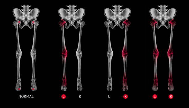 radiographie des os de jambe normale d’alignement ou de la position neutre jambe os vue antérieure rouge mettez en surbrillance dans l’arthrite de hanche-genou-cheville douleurs articulaires zone-3d medical illustration humain anatomie concept-sur fon - human joint human knee pain x ray photos et images de collection
