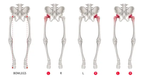 Varus alignment of leg or Bowlegs bone collection with red highlights on Hip Arthritis and hip joint area-Healthcare-Human Anatomy and Medical concept-Isolated on white background.
