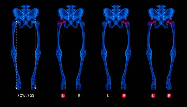 Varus alignment of leg or Bowlegs bone X-ray blue film collection with red highlights on Hip Arthritis and hip joint area-Healthcare-Human Anatomy and Medical concept-Isolated on black background.