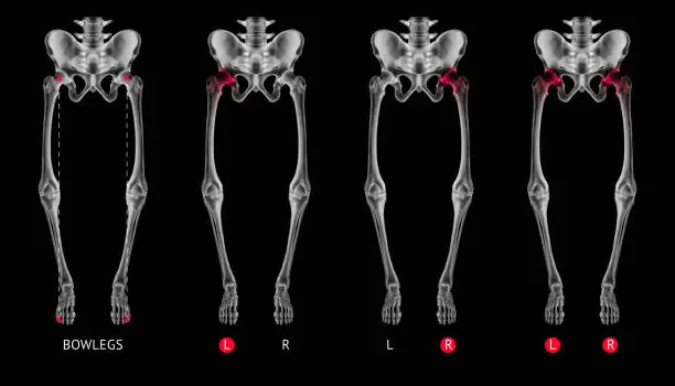 Varus alignment of leg or Bowlegs bone X-ray film collection with red highlights on Hip Arthritis and hip joint area-Healthcare-Human Anatomy and Medical concept-Isolated on black background.