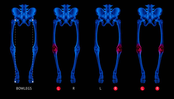 alignement de varus de jambe ou os bowlegs collection blue film radiographie avec rouge met en évidence sur les douleurs articulaires du genou zone-healthcare-human anatomy et medical concept-isolé sur fond noir. - human joint human knee pain x ray photos et images de collection