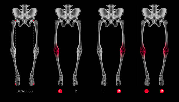 alignement de varus de jambe ou os bowlegs collection de films de radiographie avec rouge met en évidence sur les douleurs articulaires du genou zone-healthcare-human anatomy et medical concept-isolé sur fond noir. - human knee pain human spine human joint photos et images de collection