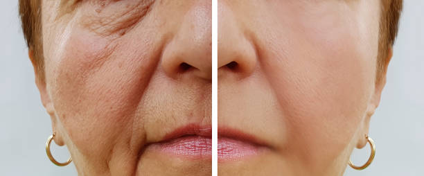 istock elderly woman wrinkles face before and after procedures 1028282334