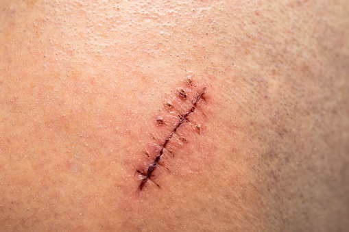 Close up of head injury with visible stitches on the skin.
