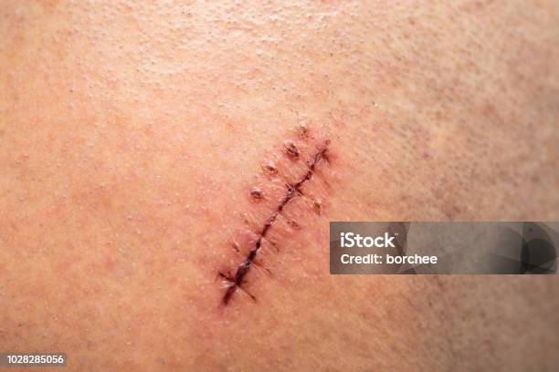 Head Injury Stock Photo - Download Image Now - Head, Medical Stitches, Stitching