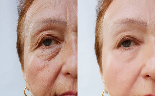 istock elderly woman wrinkles face before and after cosmetic procedures 1028292016