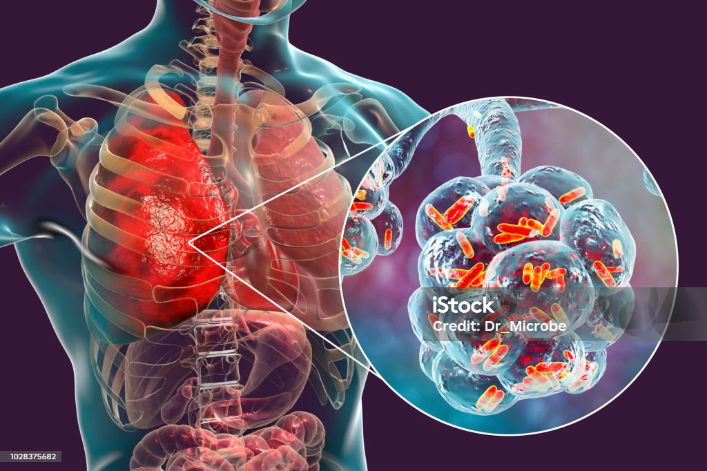 Bacterial pneumonia, medical concept Bacterial pneumonia, medical concept. 3D illustration showing rod-shaped bacteria inside alveoli of the lung Pneumonia Stock Photo