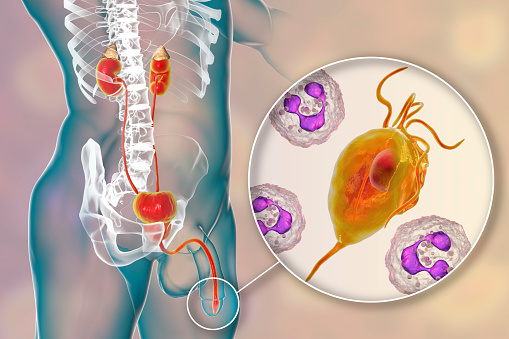 Trichomoniasis infection in man, 3D illustration showing male anatomy of genitourinary system and close-up view of Trichomonas vaginalis protozoan causing urethritis