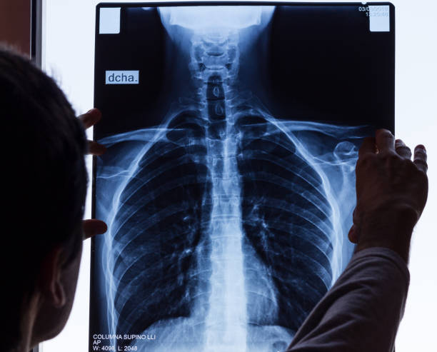 doctor checking on chest x-ray - pain rib cage x ray image chest imagens e fotografias de stock