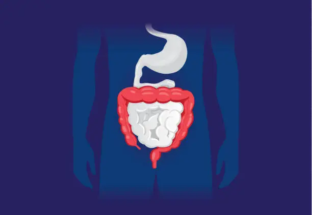 Illustration about abnormal symptom of human large Intestine. Illustration about abnormal symptom of human large Intestine. Disease about Digestive system. Bowel and Intestinal Problems cartoon stock illustrations