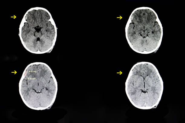 brain subdural hematoma CT scan of a brain of a 4 year old child with a history of crush injury (hit by a falling TV) showing a small subdural hematoma in his right frontotemporal cerebral area. hematoma images stock pictures, royalty-free photos & images