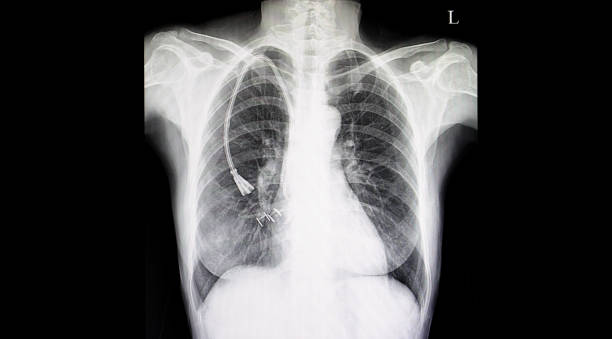 istock Chest xray film double lumen catheter 1028675978