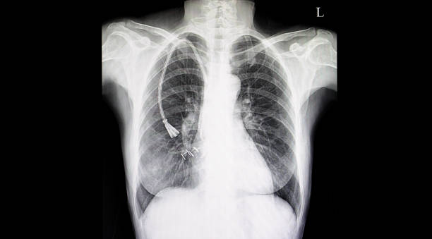 Chest xray film double lumen catheter Chest xray film of a patient with double lumen catheter in his right superior venacava vein. Central line for hemodialysis. catheter stock pictures, royalty-free photos & images