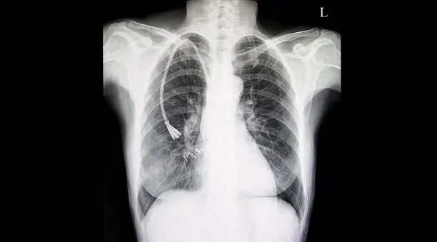 Chest xray film of a patient with double lumen catheter in his right superior venacava vein. Central line for hemodialysis.