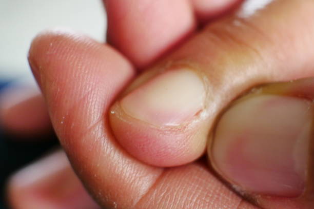 istock Damaged womans nail close up 1029265612