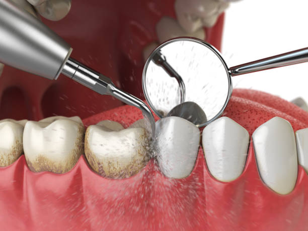 professionelle zahnreinigung. ultraschall-zahnreinigung maschine löschen zahnstein von menschlichen zähnen. - dental hygiene stock-fotos und bilder