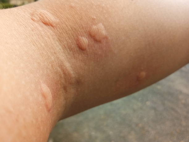 istock skin allergies, Arm skin men. 1029902938