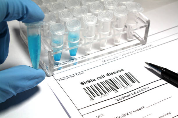 Sickle cell disease research stock photo