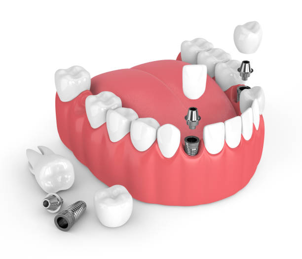 3d render de la mandíbula con implantes dentales - premolar fotografías e imágenes de stock