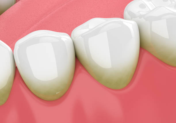 istock 3d render of teeth with plaque and tartar 1030184652