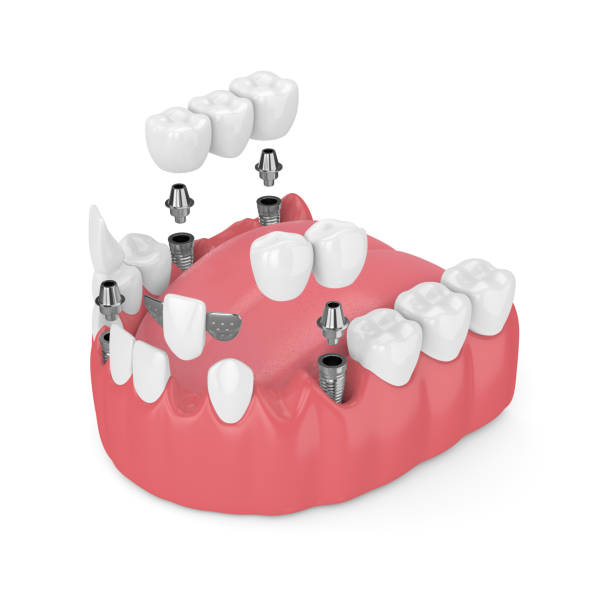 istock 3d render of jaw with dental implants and bridges 1030187436
