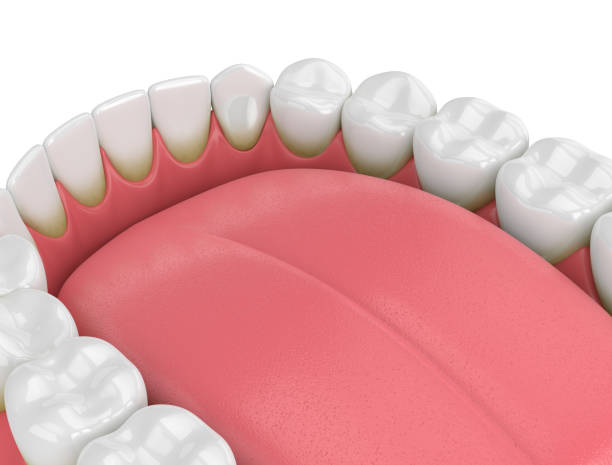 istock 3d render of teeth with plaque and tartar 1030188618