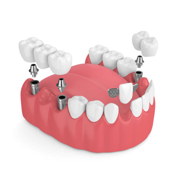 3d render de la mandíbula con implantes dentales y puentes - premolar fotografías e imágenes de stock