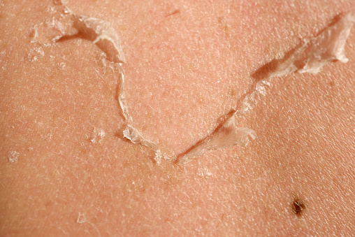 macro shot of sunburned skin, woman back with skin peeling off.