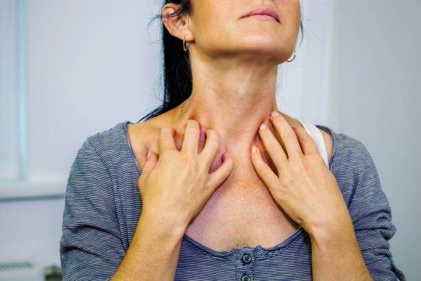 istock Woman scratching itchy neck 1030299464