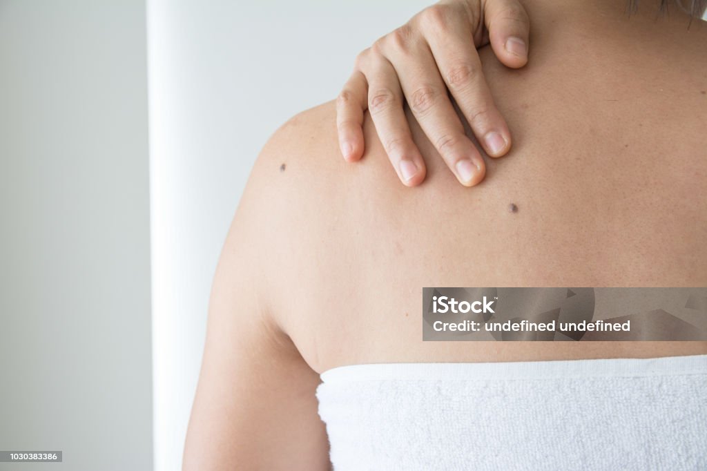 Mollen op de huid van vrouwen - Royalty-free Melanoom Stockfoto
