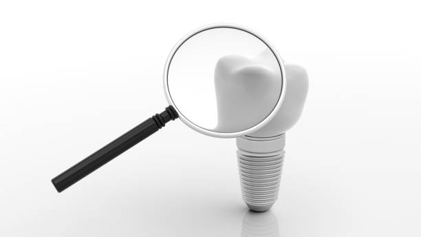 istock Dental implant and magnifier on white background. 3d illustration 1030878614