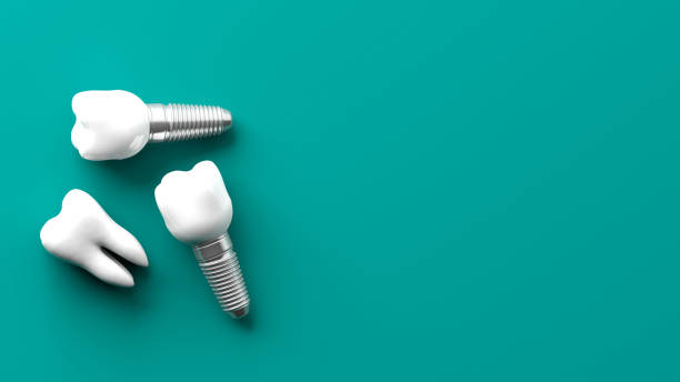 dientes aislados sobre fondo verde. ilustración 3d - teeth implant fotografías e imágenes de stock