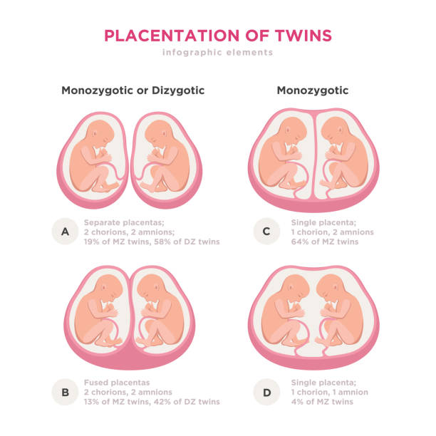 elementy infografiki typu twin typów w płaskiej konstrukcji. monozygotyczne lub dizygotyczne łożysko bliźniąt ilustracji medycznej i ikony izolowane na białym tle. - twin fetus uterus human pregnancy stock illustrations