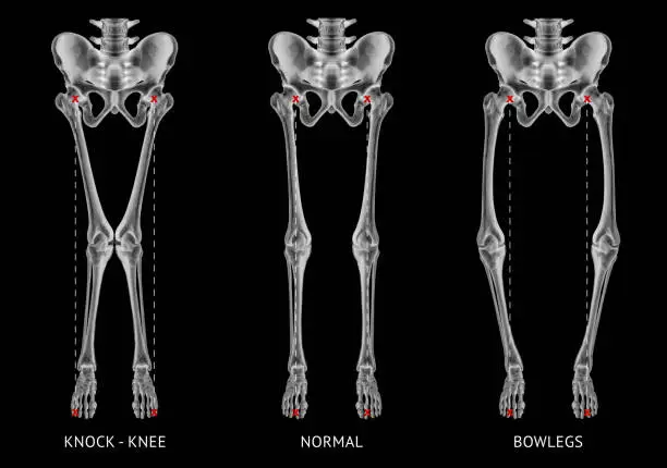 Alignment types disease leg bone problem of knock knee -Normal and Bowlegs or valgus and varus knee- 3D Medical illustration- Human Anatomy and Medical Concept- Black and white color