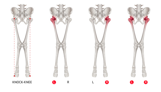 Valgus Valgus Alignment Leg Or Knockknee Red Highlights On Hip Joint Area ...