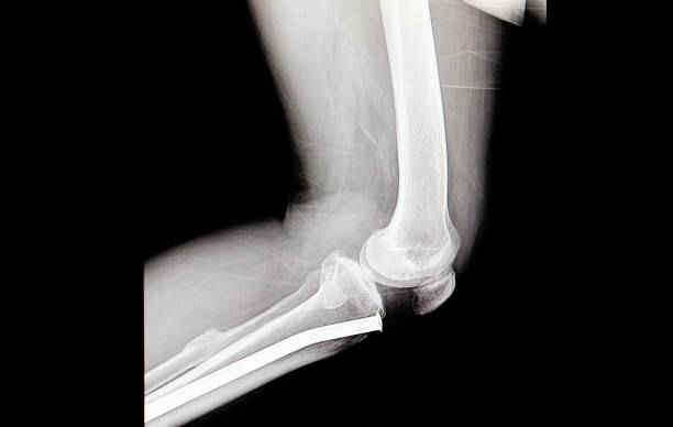 istock orthopedic nail in the tibia 1031343874