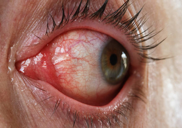 istock Red Eye with the Disease of Conjunctivitis 1031355276