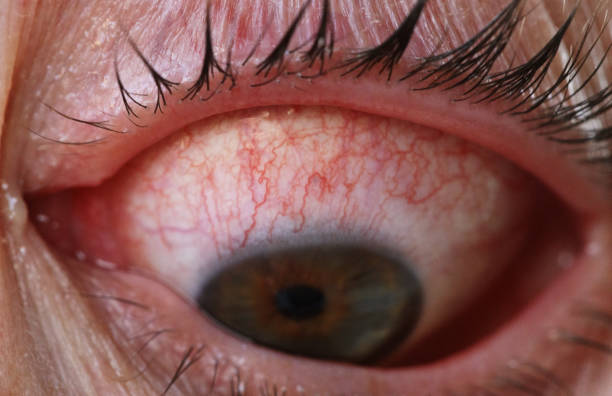 istock Red Eye with the Disease of Conjunctivitis 1031355280
