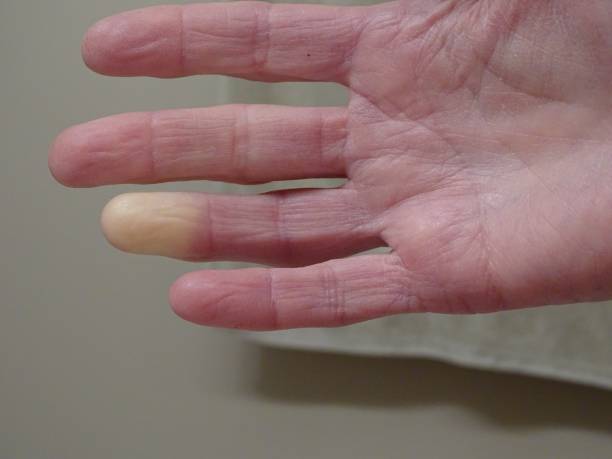 istock Adult hand with Raynaud’s Syndrome 1031733952