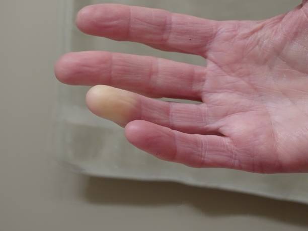 istock Adult hand with Raynaud’s Syndrome 1031733976