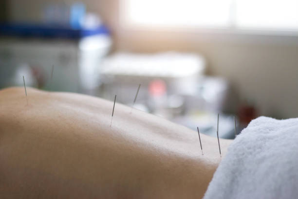 istock Traditional Chinese Medicine Treatment,Acupuncture 1031860264